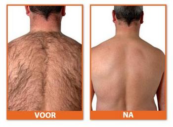 Meer informatie over permanente rugontharing https://www.beautyconsult.be/tags/rug-ontharing