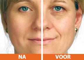 Wij houden van een gezonde huid zonder botox! Een gezonde anti-rimpel behandeling zonder botox!