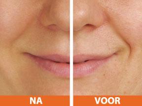 Zonder rimpels en met behoud van je natuurlijke look! mesolift anti-aging de antirimpelbehandeling zonder botox