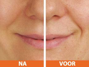 mesolift anti-aging de antirimpelbehandeling zonder botox