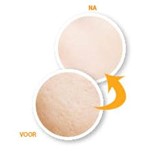 Voor en Na behandeling Microneedling  ronde huid grof en glad